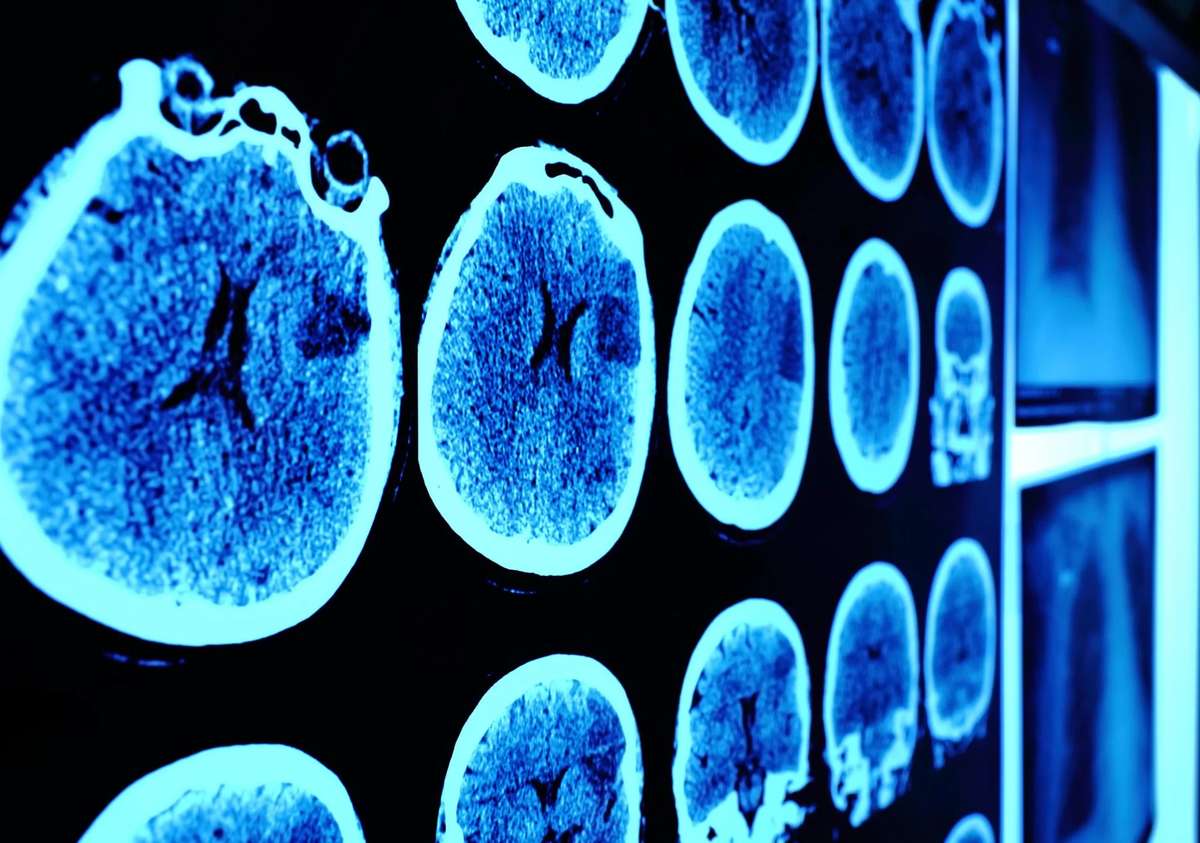 Machine Learning Enhances Brain Image Data Quality in MRI : A Brief Overview